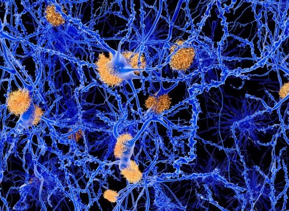 Alzheimer ile Sirkadiyen Ritimler Arasındaki Bağlantı
