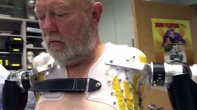  İki omzuna da protez kol yerleştirilen ilk insan