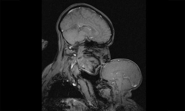 Bir Annenin Bebeğine Olan Aşkı MR İle Görüntülendi